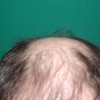 Лечение выпадения волос. Плазмолифтинг - результаты